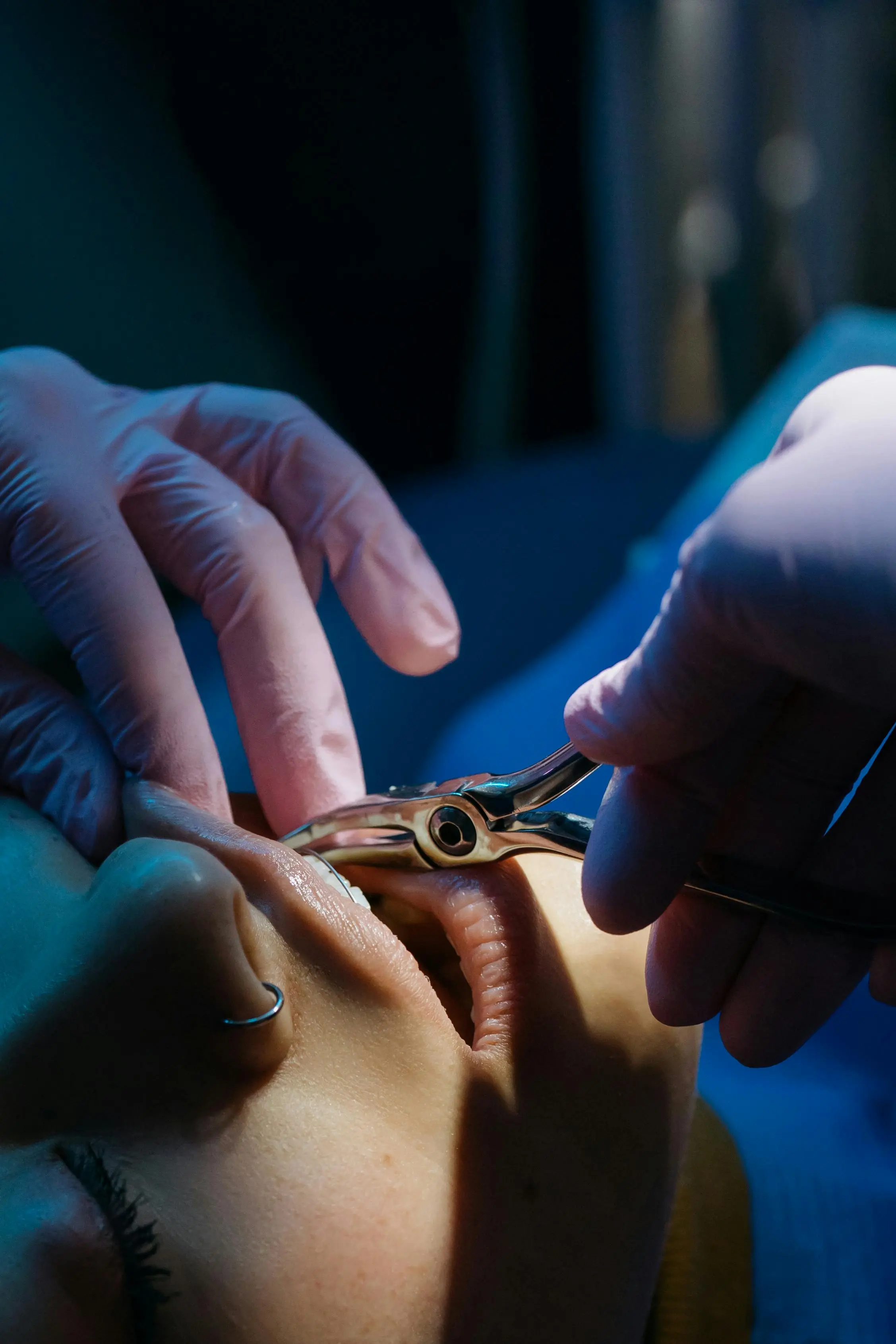 Tooth Extractions